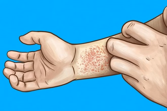 Da khô và ngứa là dấu hiệu điển hình khi thận không còn khả năng duy trì sự cân bằng khoáng chất và dưỡng chất thiết yếu. Ảnh: Thanh Vân